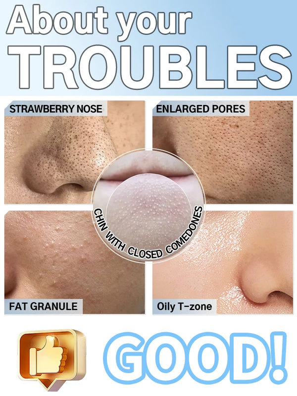 Blackhead Buster Vacuum